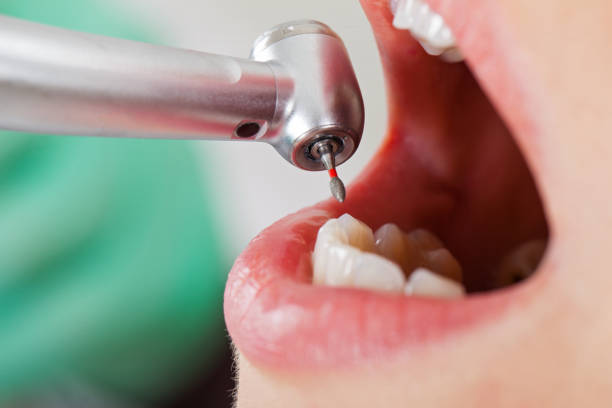 Best Emergency Dental Extractions in Springdale, MD